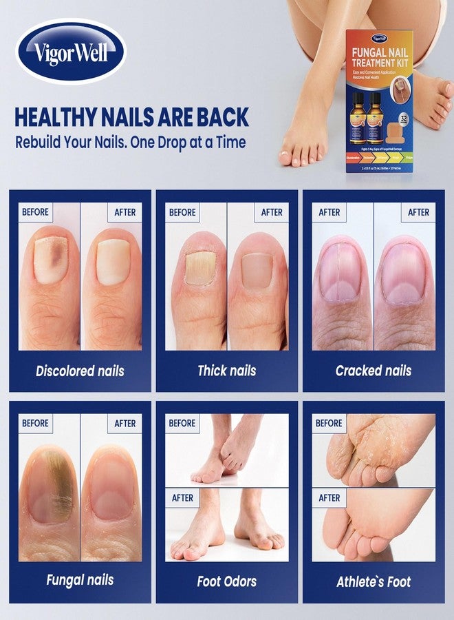 VigorWell Toenail Treatment Extra Strength: Dual Action Nail Repair Kit for Thick, Brittle or Discolored Nails - 30 ml Nail Repair Gel with 25% Undecylenic Acid - (Medium) 32 Nail Patches - Image 2